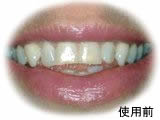 These teeth can be lengthened with porcelain veneers