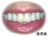 These teeth can be lengthened with porcelain veneers