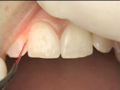 Dental Laser