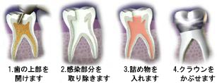 Pulpectomy procedure