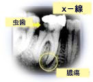 X-Ray of a tooth needing root canal therapy