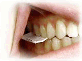 Bitewing X-Ray film placed in mouth
