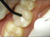 Dental Sealants help prevent cavities.